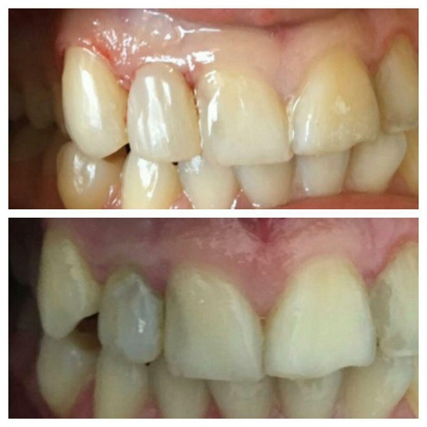 اصلاح رنگ دندان و اندازه دندان پیشین کناری اصلاح فرم دندان نیش و قراردادن در قوس فکی