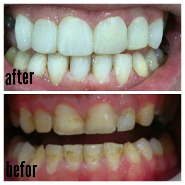 اصلاح رنگ واندازه دندانها بوسیله کامپوزیت(لمینت کامپوزیتی)