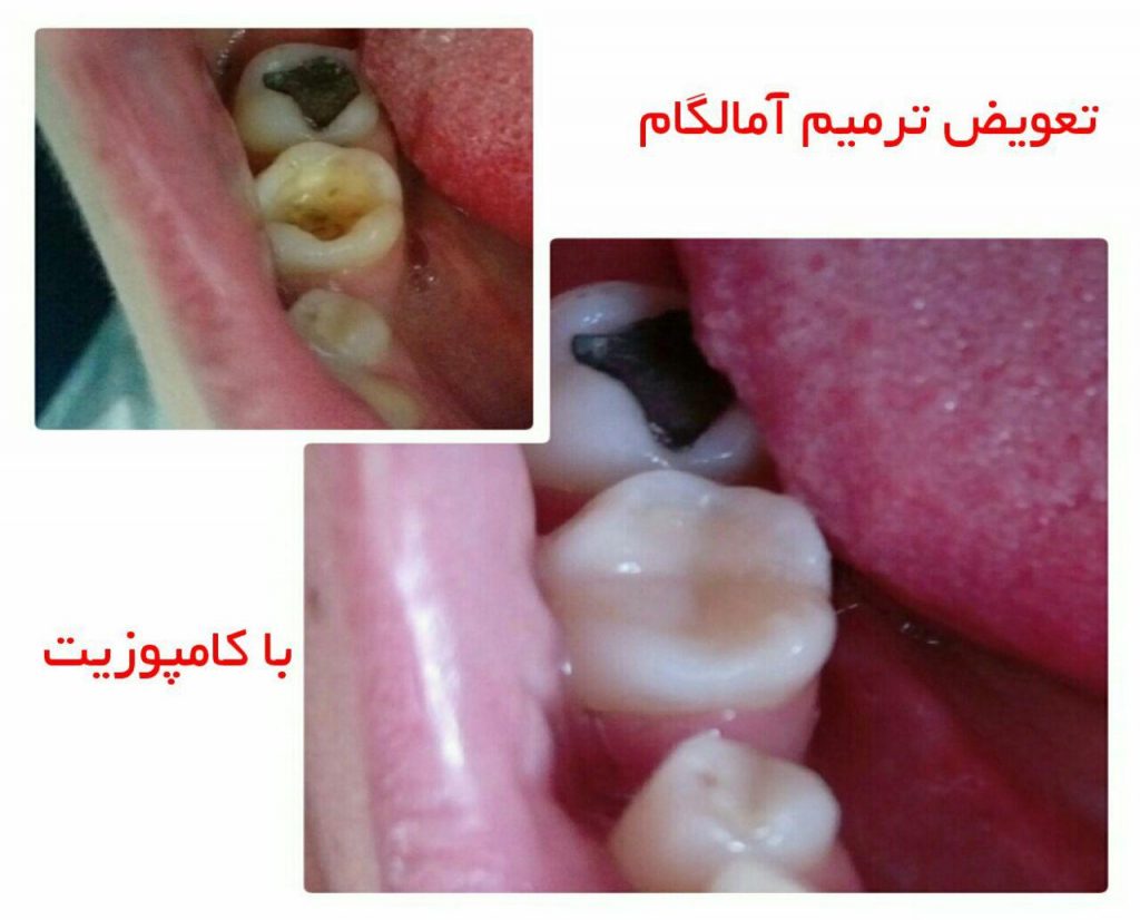تعویض آمالگام با کامپوزیت