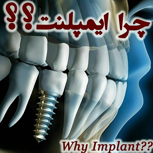 ایمپلنت