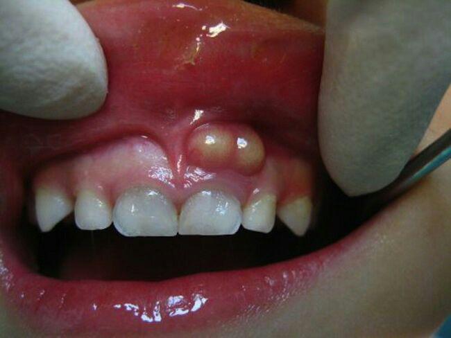 علت کیست های دندانی چیست؟
