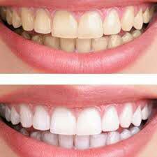 ‌روش های سفید کردن دندان