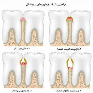 مراحل پیشرفت بیماری پریودنتال در قاب تصویر