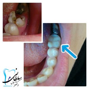 بازسازی دندان با مواد همرنگ