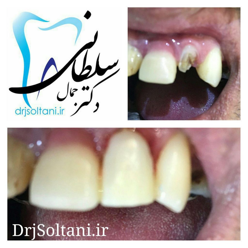 بازسازی تاج دندان پیشین با کامپوزیت