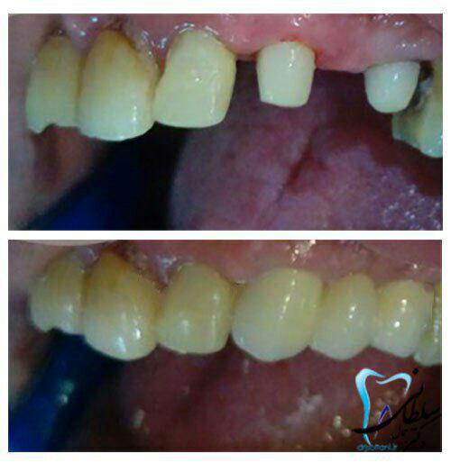 پروتز ثابت دندان نیش و دو آسیای کوچک