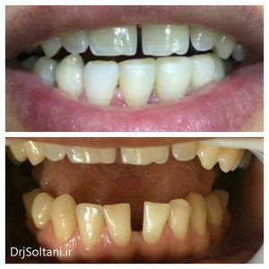 بستن فاصله بین دندانها و اصلاح شکل؛ رنگ و اندازه