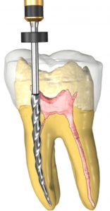 مراقبت های پس از درمان ریشه دندان