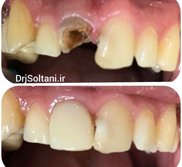 بازسازي تاج دندان پيشين