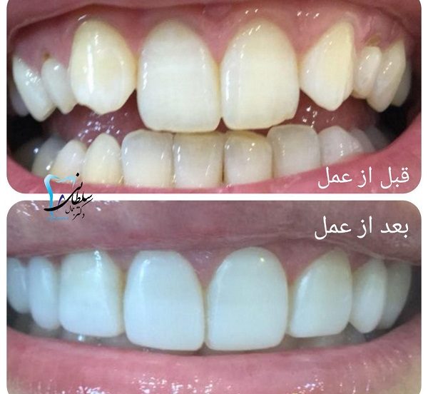 لمینت کامپوزیتی