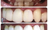نمونه کار دندانپزشکی؛ لمینت کامپوزیتی همراه با اصلاح شکل و اندازه دندانها