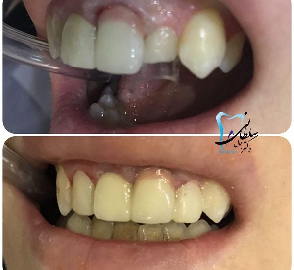 تغییر شکل و اندازه دندان جلویی و قراردادن آن در یک ردیف با بقیه دندانها بدون ارتودنسی و در یک جلسه