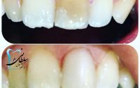 اصلاح و تغییر رنگ دندان به وسیله کامپوزیت