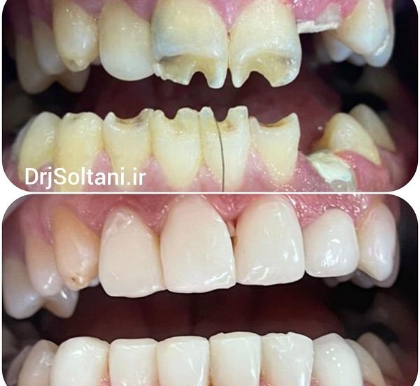 لمینت کامپوزیتی